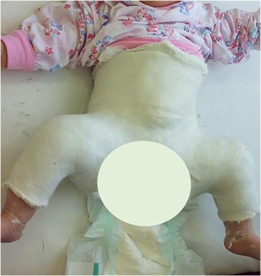 Splint Duration and Not the Mode of Anesthesia Is the Main Factor Influencing Avascular Necrosis After Closed Reduction for Developmental Dysplasia of the Hip in Kosovo